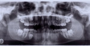 tooth xray