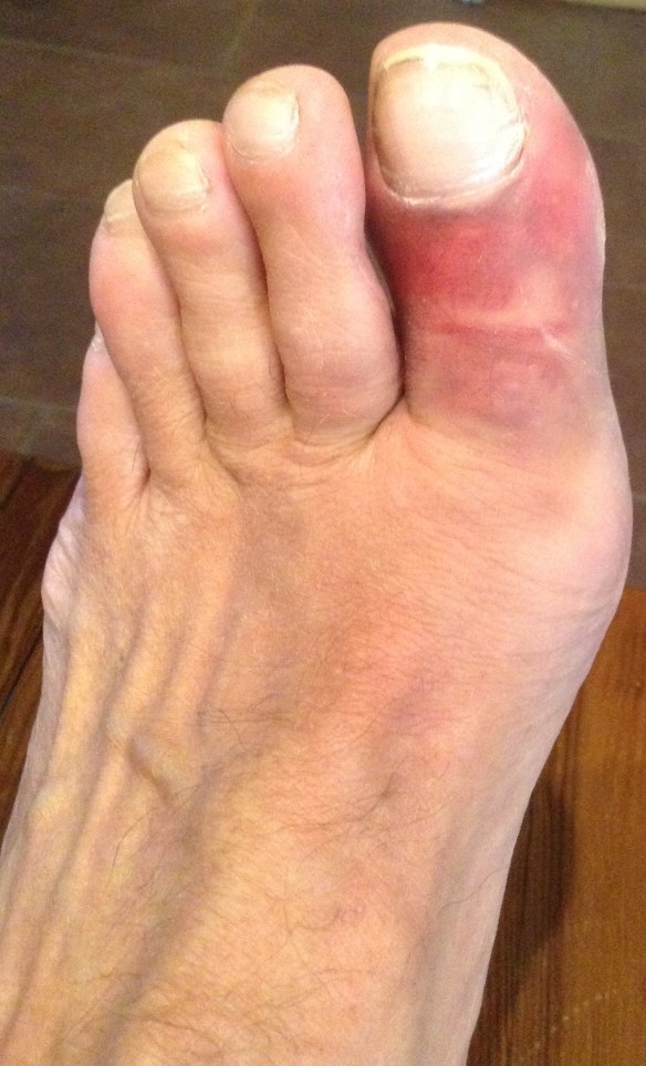 This what a toe looks like when it's fractured in three places, like dropping a rock on ice. Luckily the doctor was in on Christmas Eve morning. I was one of many patients there who has broken a toe the night before. I can also add that when it happened it hurt a lot, making me nauseous for a minute. Afterward I walked a few miles on my treadmill and was amazed how much it hurt. Yes, I'm an idiot.    